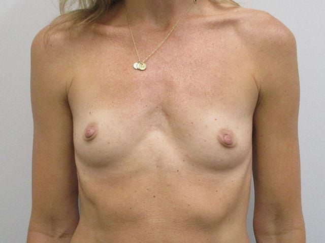 Breast Augmentation Before & After