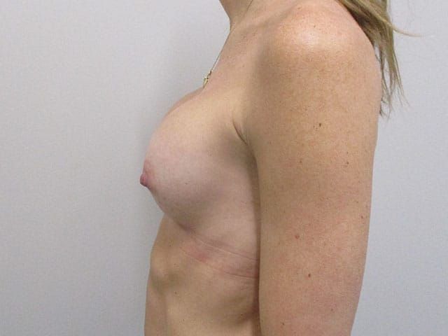Breast Augmentation Before & After