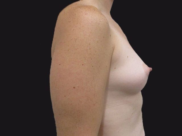 Breast Augmentation Before & After