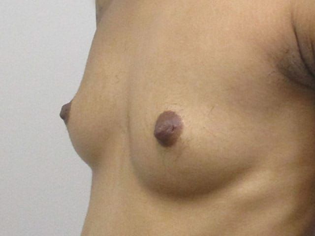 Breast Augmentation Before & After