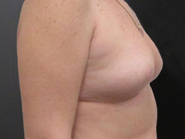 Breast Augmentation Before & After