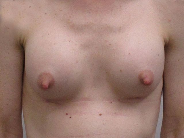 Breast Augmentation Before & After