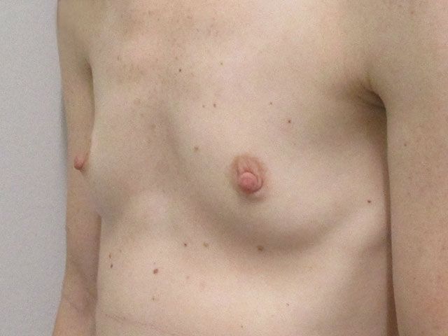 Breast Augmentation Before & After