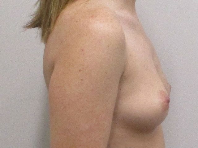 Breast Augmentation Before & After