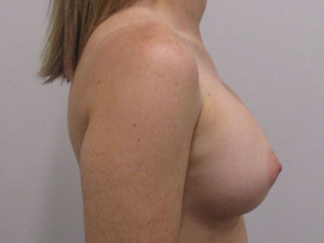 Breast Augmentation Before & After