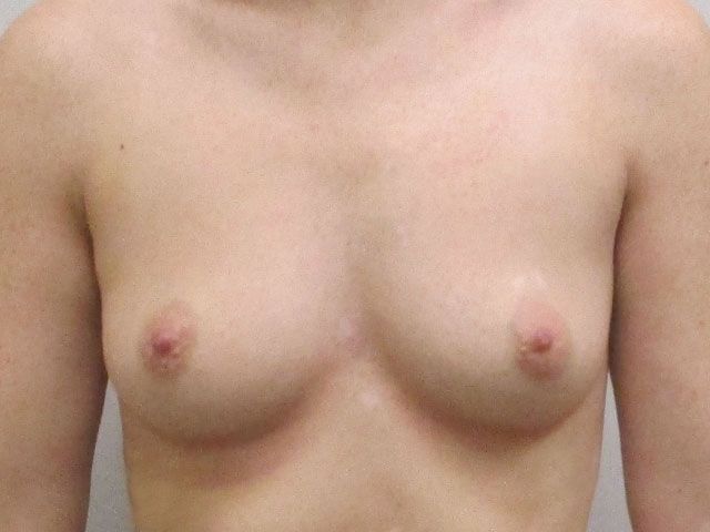 Breast Augmentation Before & After