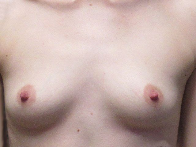 Breast Augmentation Before & After