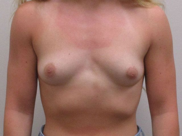Breast Augmentation Before & After