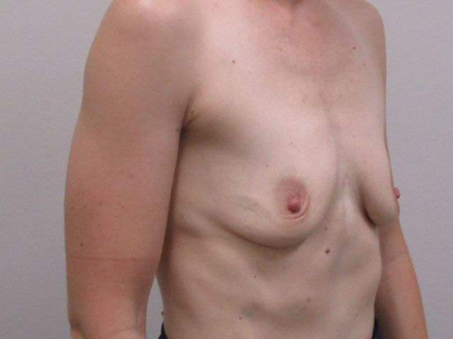 Breast Augmentation Before & After