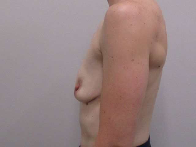 Breast Augmentation Before & After