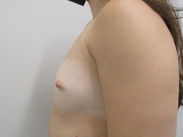 Breast Augmentation Before & After