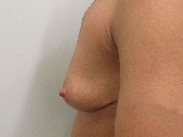 Breast Augmentation Before & After