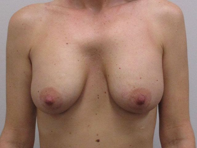 Breast Augmentation Before & After