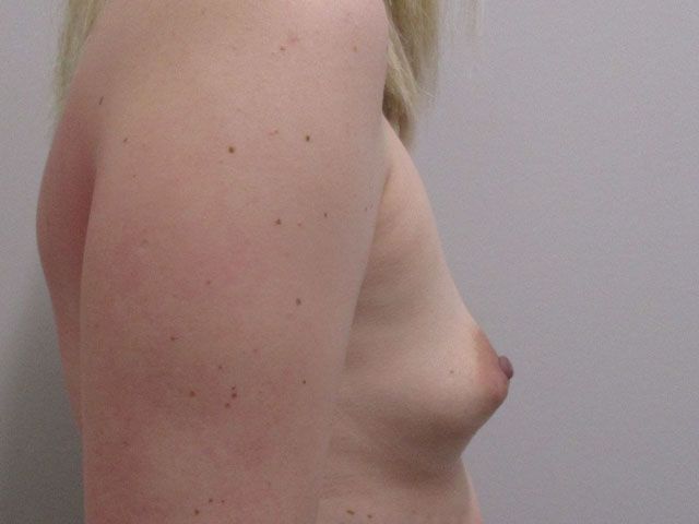 Breast Augmentation Before & After