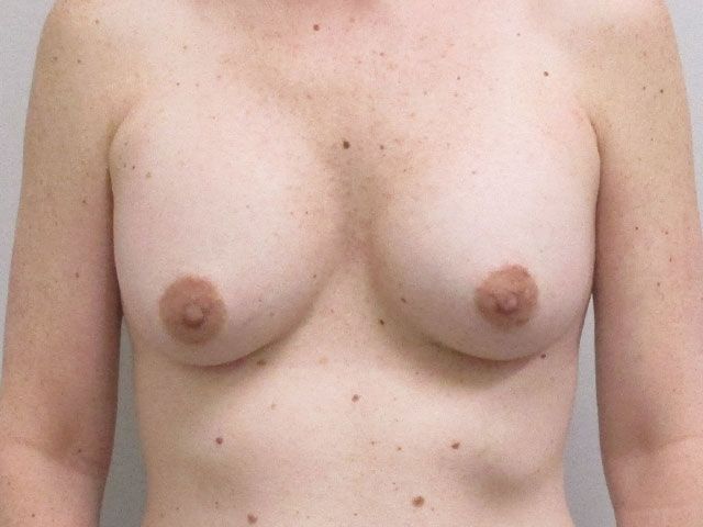 Breast Augmentation Before & After