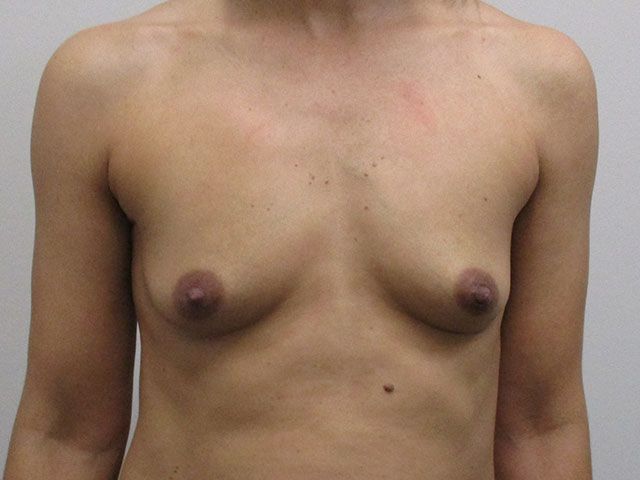 Breast Augmentation Before & After