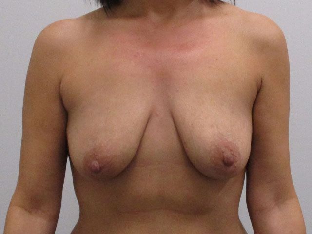 Breast Augmentation Before & After