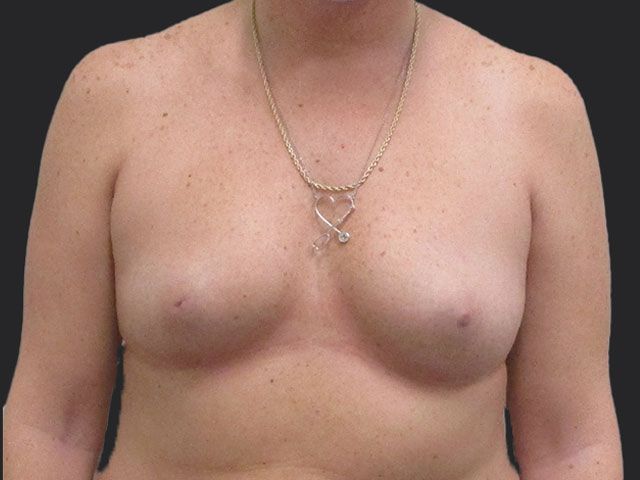 Breast Augmentation Before & After