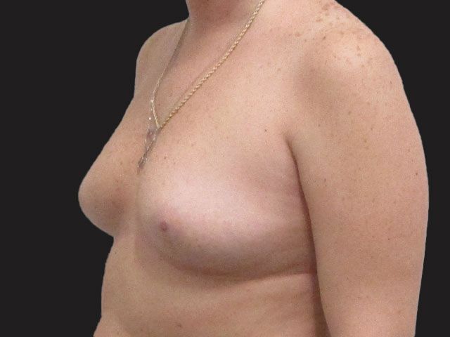 Breast Augmentation Before & After
