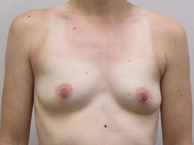 Breast Augmentation Before & After