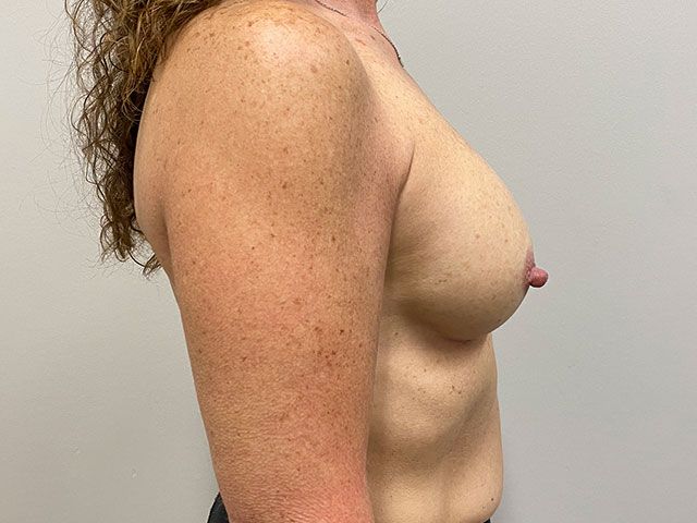 Breast Augmentation Before & After