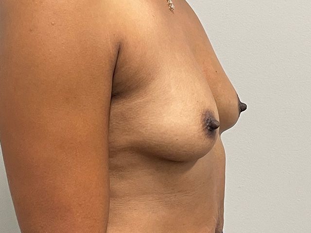 Breast Augmentation Before & After