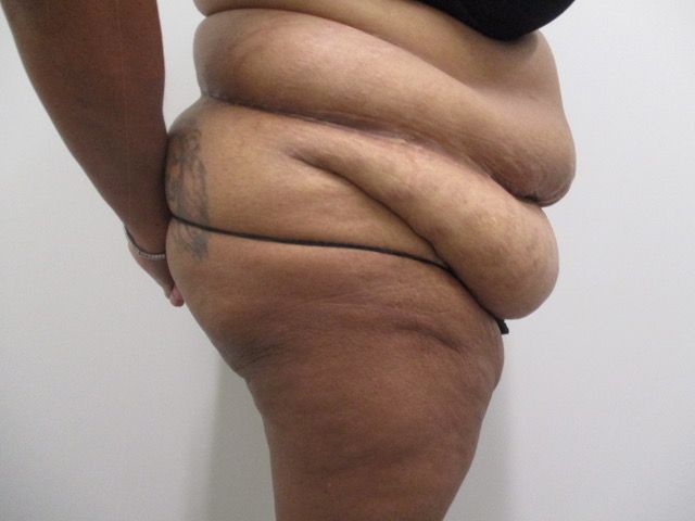 Abdominoplasty Before & After