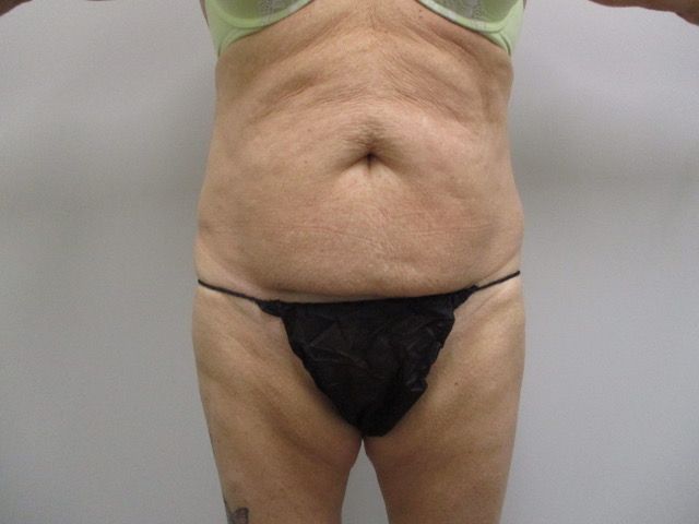 Abdominoplasty Before & After