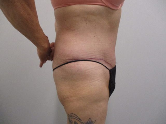 Abdominoplasty Before & After