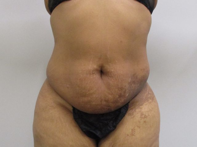 Abdominoplasty Before & After