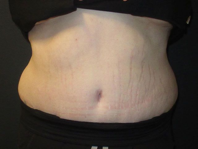 Abdominoplasty Before & After