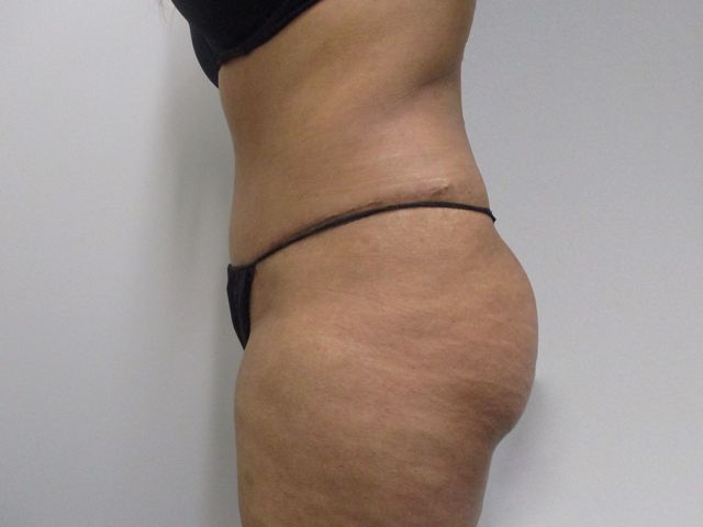 Abdominoplasty Before & After