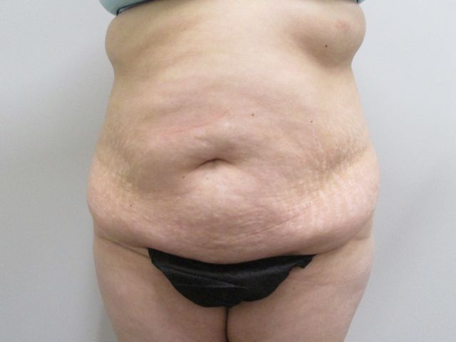 Abdominoplasty Before & After