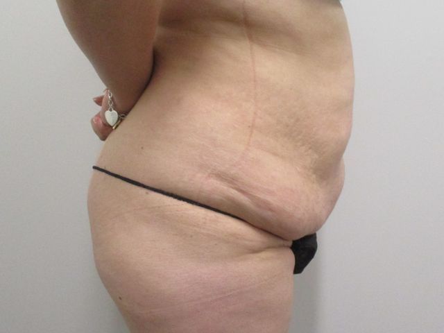 Abdominoplasty Before & After