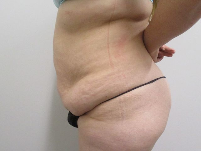 Abdominoplasty Before & After