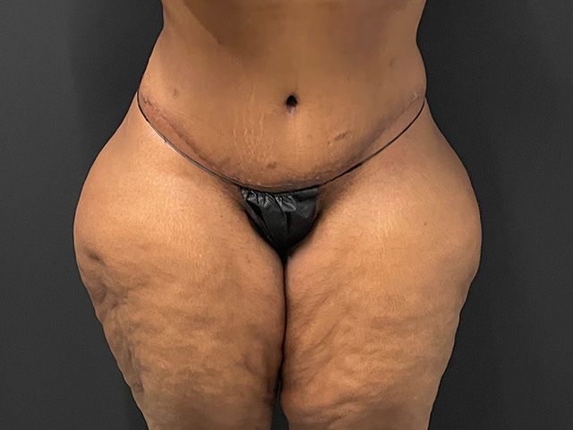 Abdominoplasty Before & After