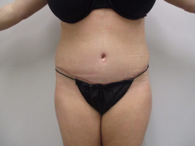 Abdominoplasty Before & After