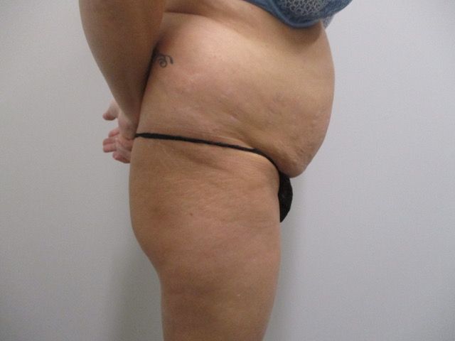 Abdominoplasty Before & After