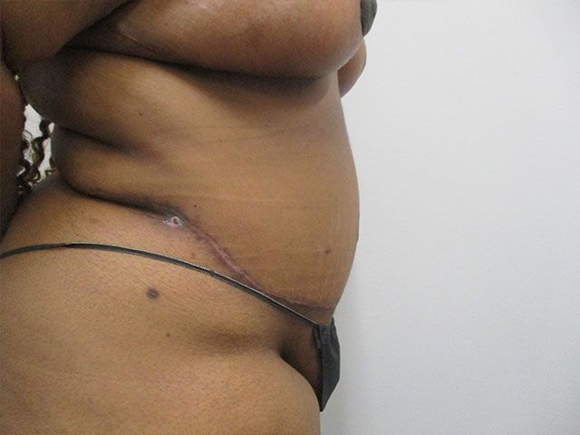 Abdominoplasty Before & After
