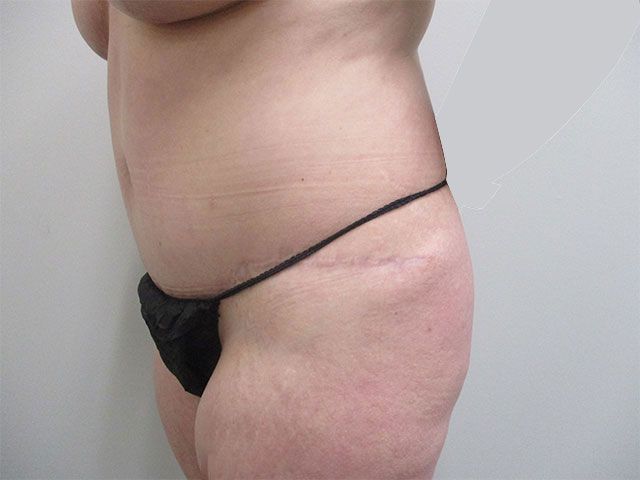 Abdominoplasty Before & After
