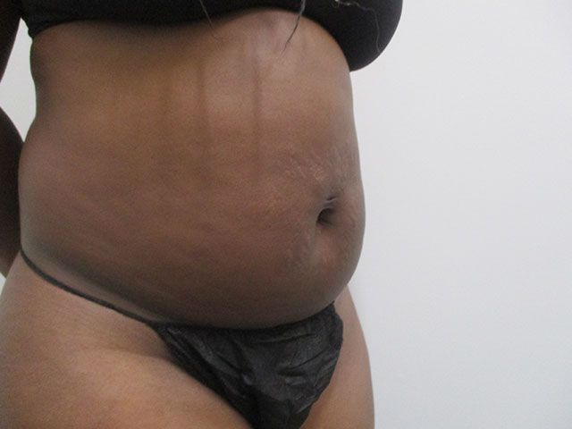 Abdominoplasty Before & After