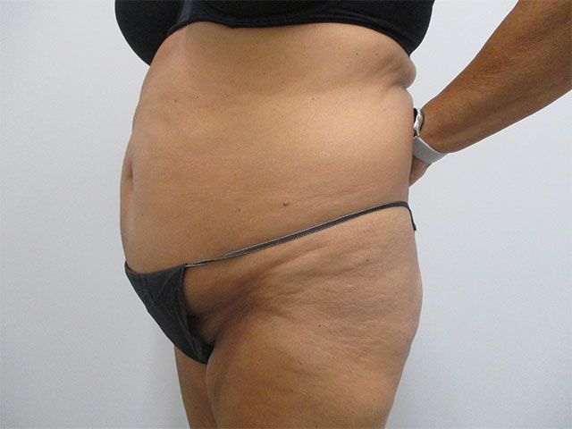 Abdominoplasty Before & After