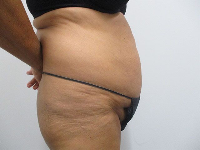 Abdominoplasty Before & After
