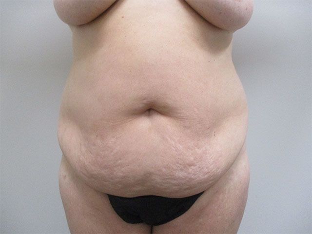 Abdominoplasty Before & After