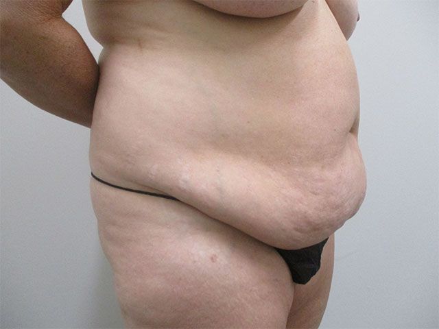 Abdominoplasty Before & After
