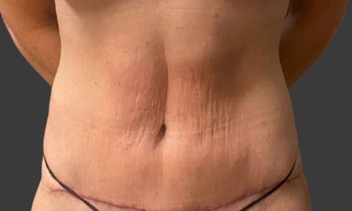 Abdominoplasty Before & After