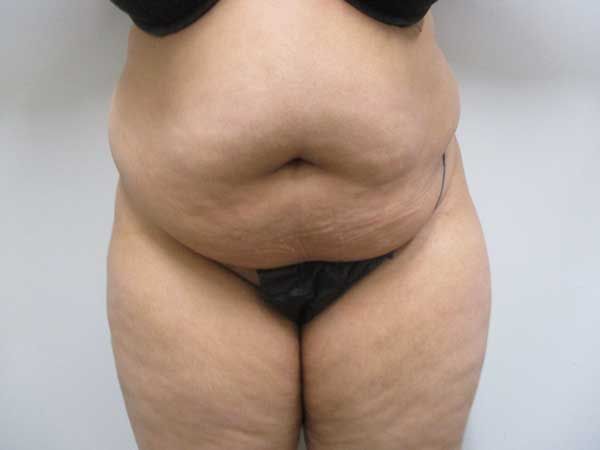 Abdominoplasty Before & After