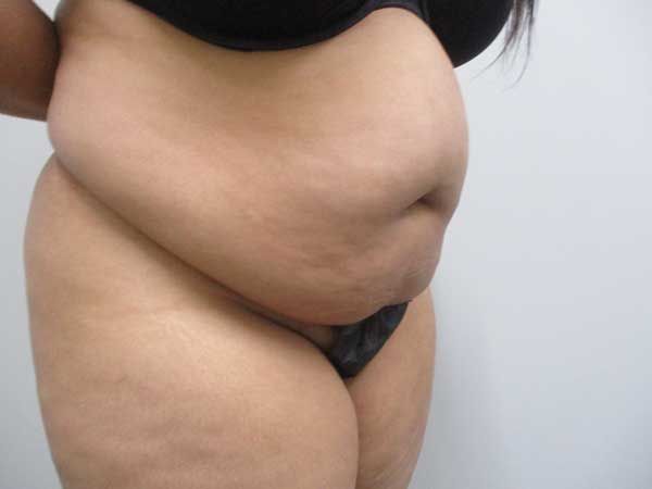 Abdominoplasty Before & After