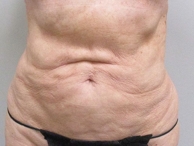 Abdominoplasty Before & After