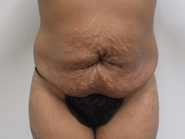 Abdominoplasty Before & After